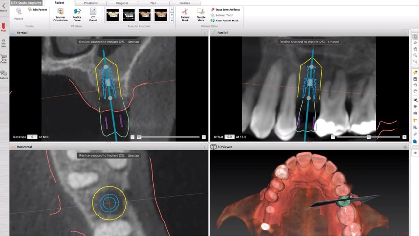 CBCT Implant Planning & Guided Surgery (=Module 5 CBCT) NL