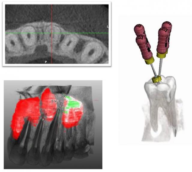 CBCT in endodontics (ENGLISH: DUTCH + FRENCH) =MODULE5