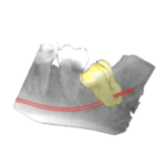 Module 4: le CBCT approfondi en pratique dentaire