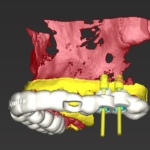  A GUIDE to beginners: intro to Guided Implant Surgery (NEDERLANDS)